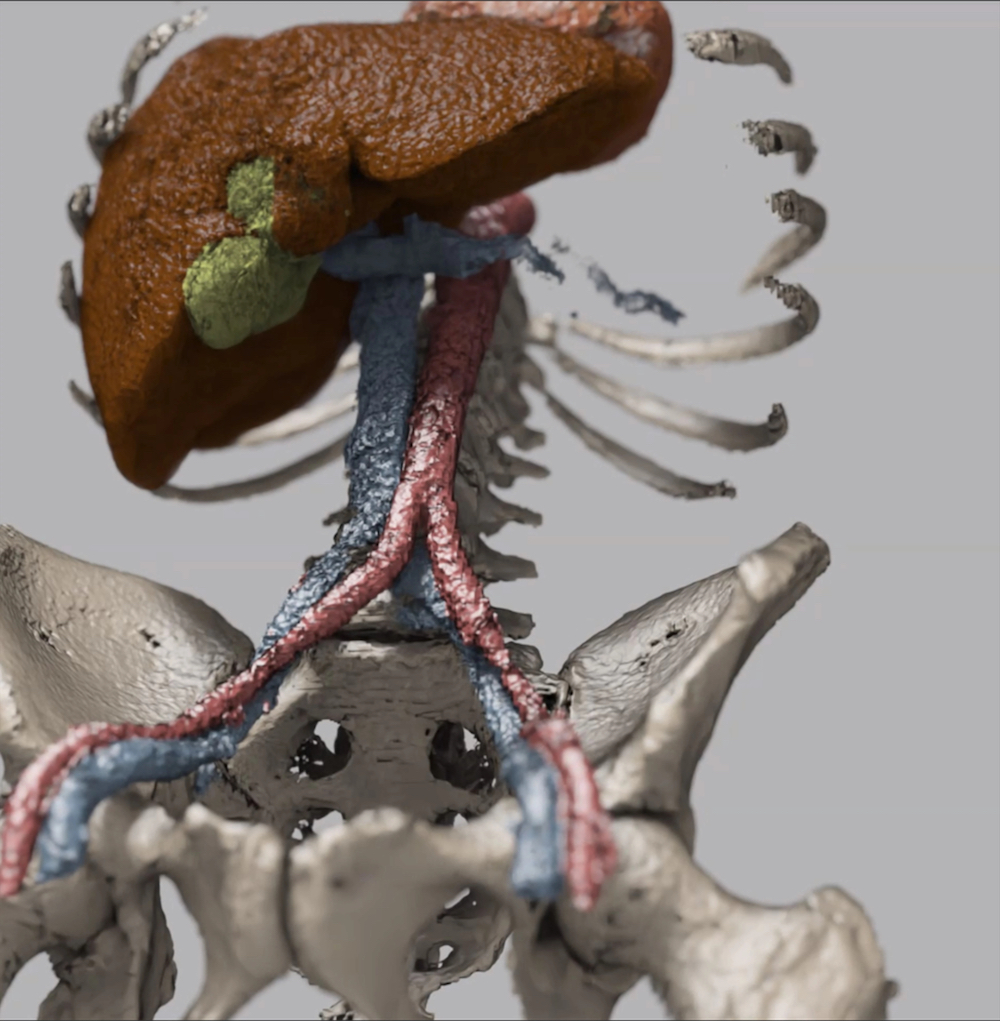 maisi Model by NVIDIA NVIDIA NIM